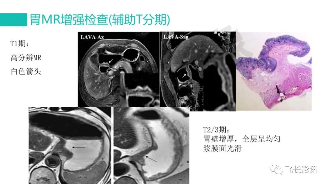 影像PPT - 【PPT】胃癌影像诊断的报告规范-41