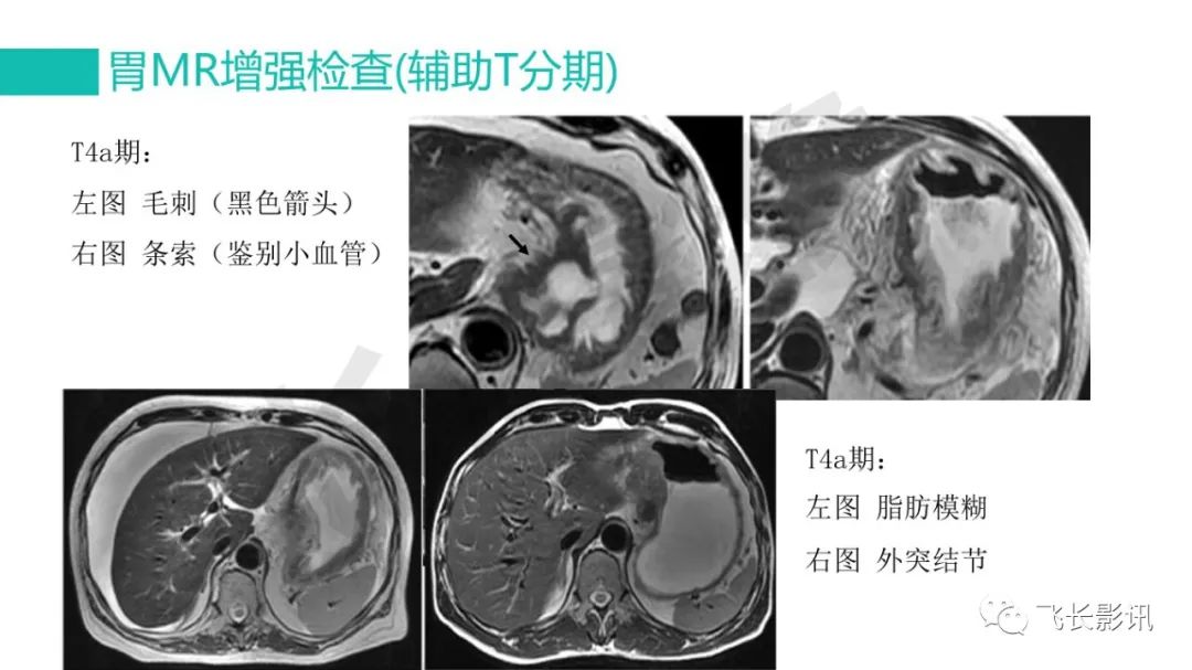 影像PPT - 【PPT】胃癌影像诊断的报告规范-42