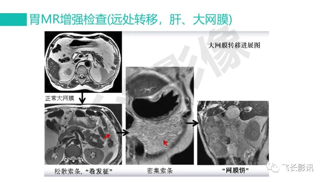 影像PPT - 【PPT】胃癌影像诊断的报告规范-43