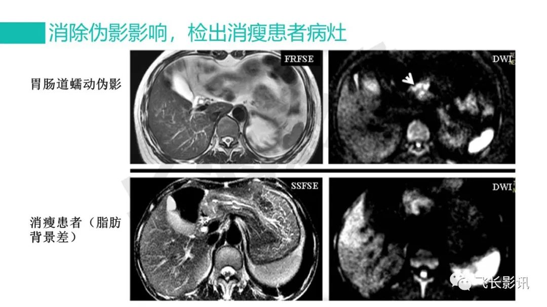 影像PPT - 【PPT】胃癌影像诊断的报告规范-46