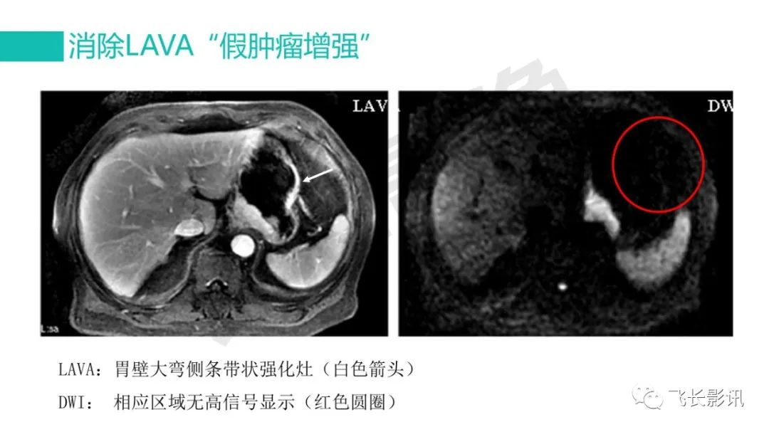 影像PPT - 【PPT】胃癌影像诊断的报告规范-48