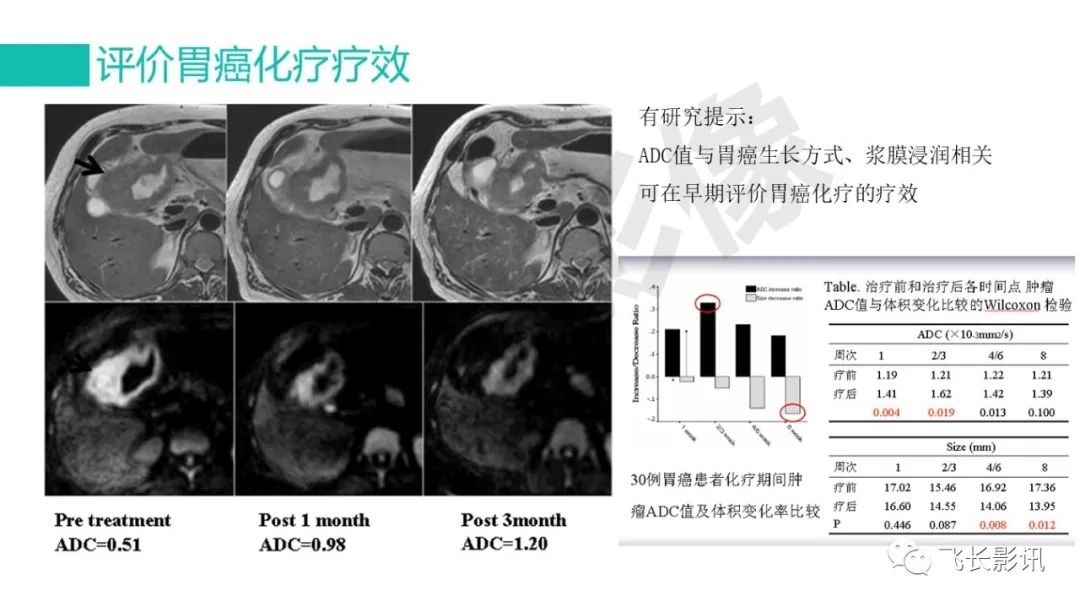 影像PPT - 【PPT】胃癌影像诊断的报告规范-49