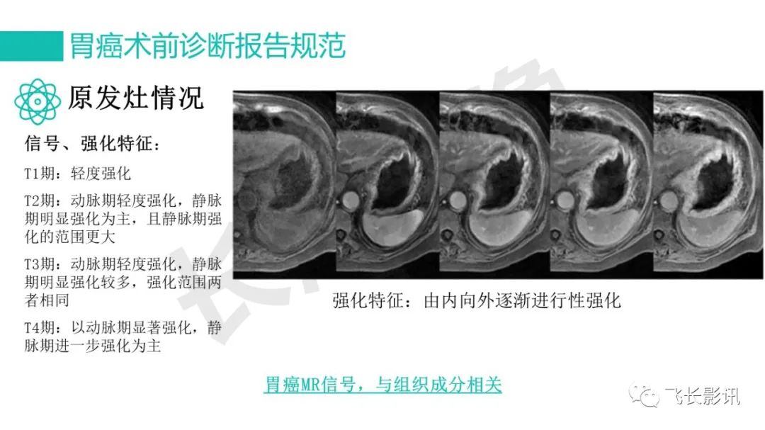 影像PPT - 【PPT】胃癌影像诊断的报告规范-54