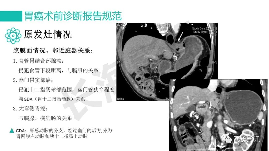 影像PPT - 【PPT】胃癌影像诊断的报告规范-55