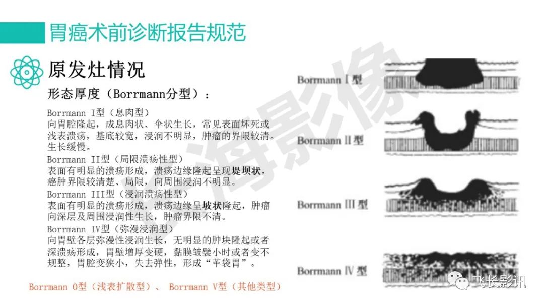 影像PPT - 【PPT】胃癌影像诊断的报告规范-53