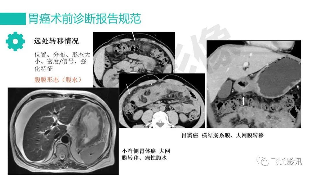 影像PPT - 【PPT】胃癌影像诊断的报告规范-57