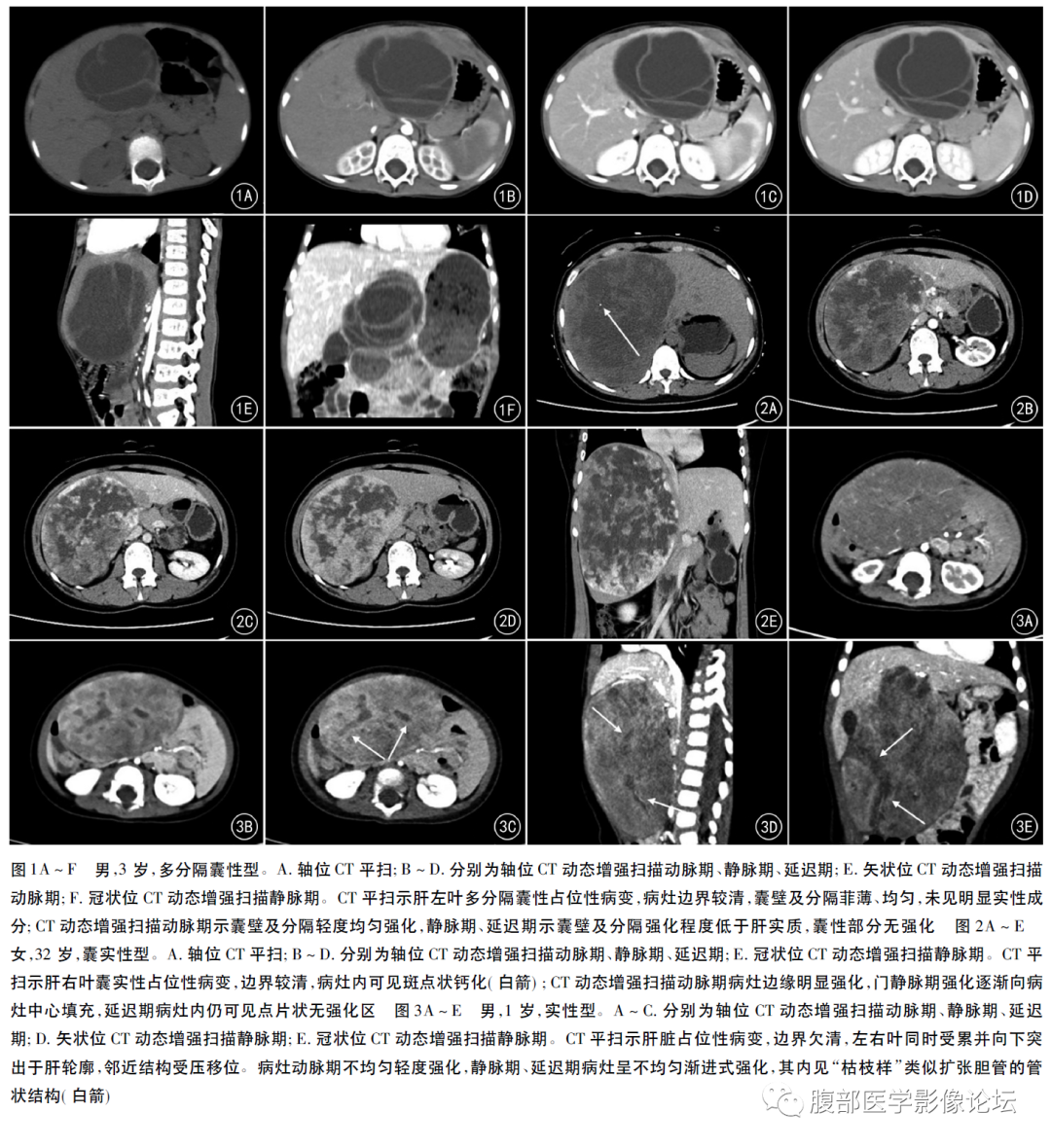 影像PPT - 【病例】肝脏间叶性错构瘤1例CT-6 影像PPT - 【病例】肝脏间叶性错构瘤1例CT-6