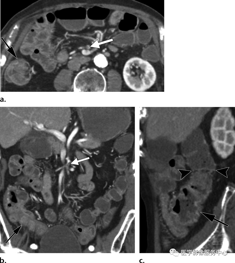 影像PPT - 肠系膜缺血在CT诊断中的要点、陷阱及鉴别诊断-4 影像PPT - 肠系膜缺血在CT诊断中的要点、陷阱及鉴别诊断-4