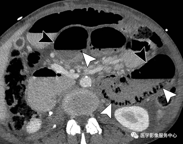 影像PPT - 肠系膜缺血在CT诊断中的要点、陷阱及鉴别诊断-13 影像PPT - 肠系膜缺血在CT诊断中的要点、陷阱及鉴别诊断-13