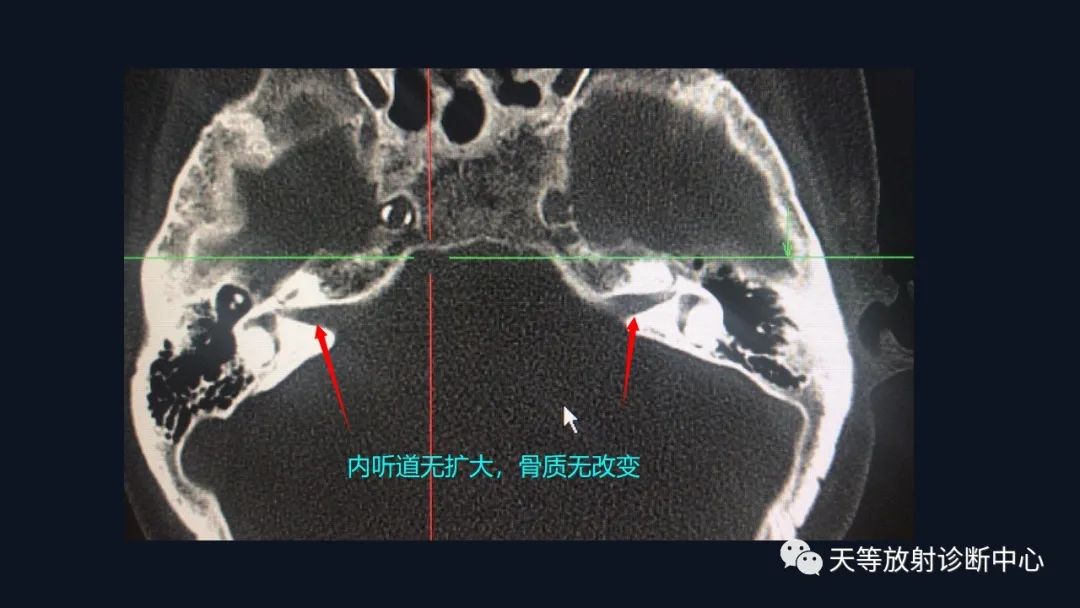 影像PPT - 脑膜瘤影像学分析-9 影像PPT - 脑膜瘤影像学分析-9