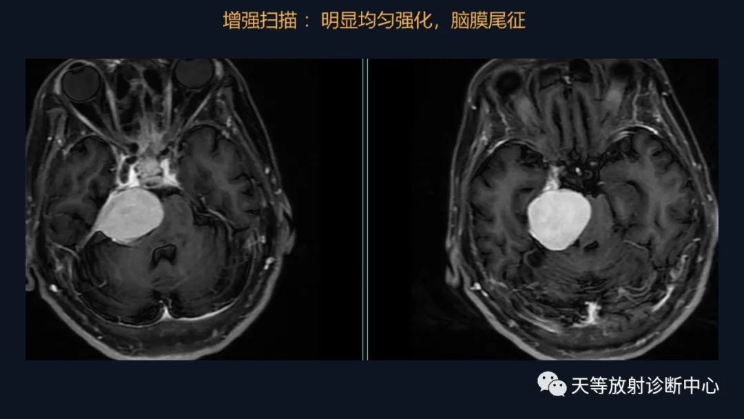 影像PPT - 脑膜瘤影像学分析-17 影像PPT - 脑膜瘤影像学分析-17