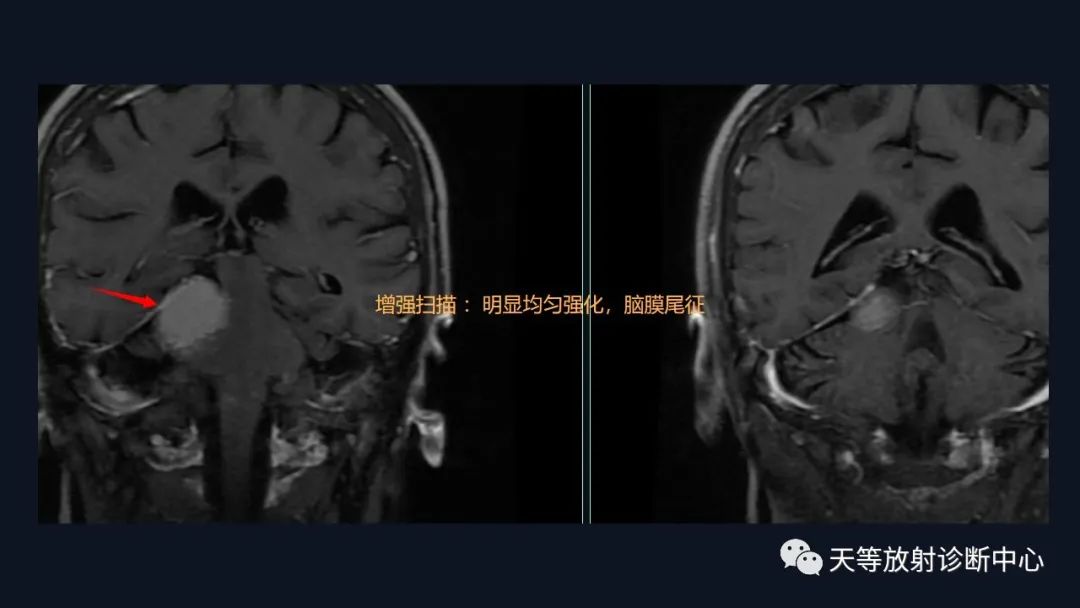 影像PPT - 脑膜瘤影像学分析-18 影像PPT - 脑膜瘤影像学分析-18
