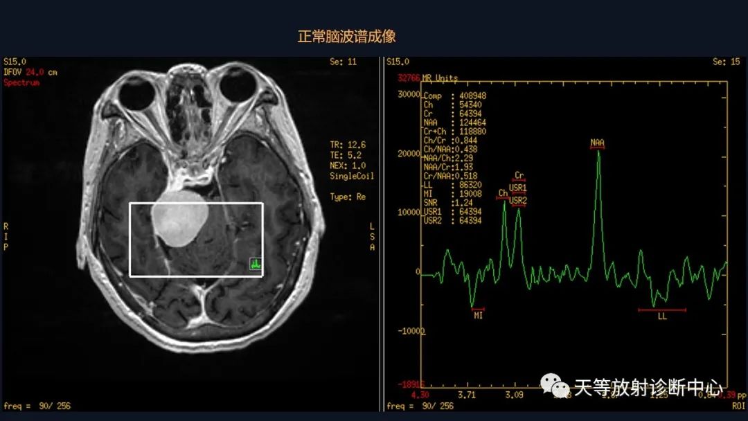 影像PPT - 脑膜瘤影像学分析-27 影像PPT - 脑膜瘤影像学分析-27