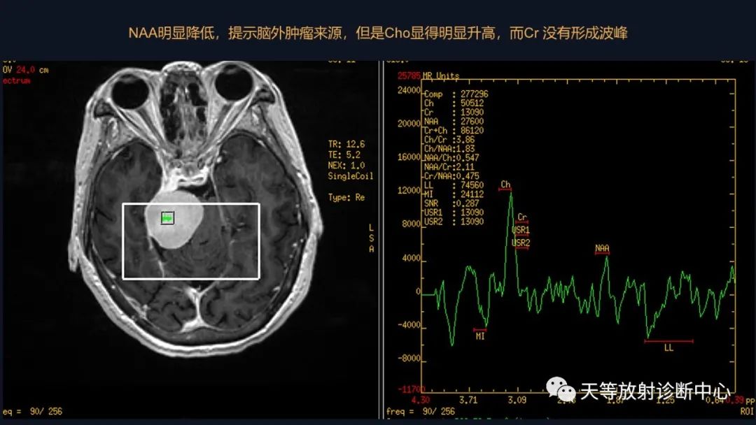影像PPT - 脑膜瘤影像学分析-32 影像PPT - 脑膜瘤影像学分析-32