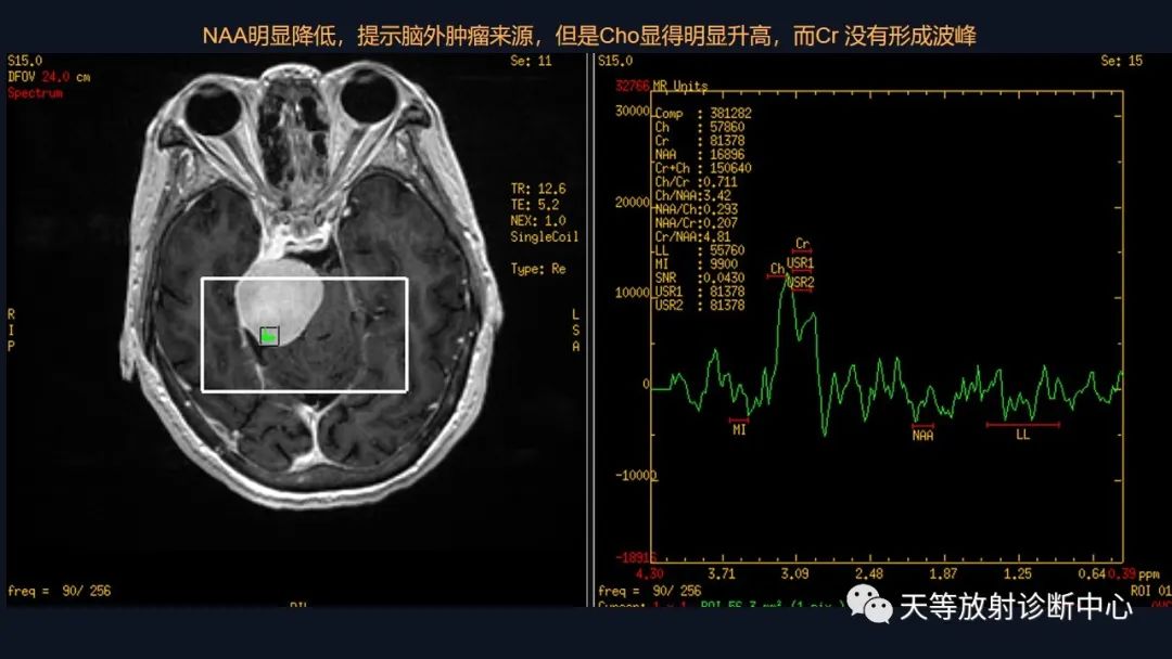影像PPT - 脑膜瘤影像学分析-33 影像PPT - 脑膜瘤影像学分析-33