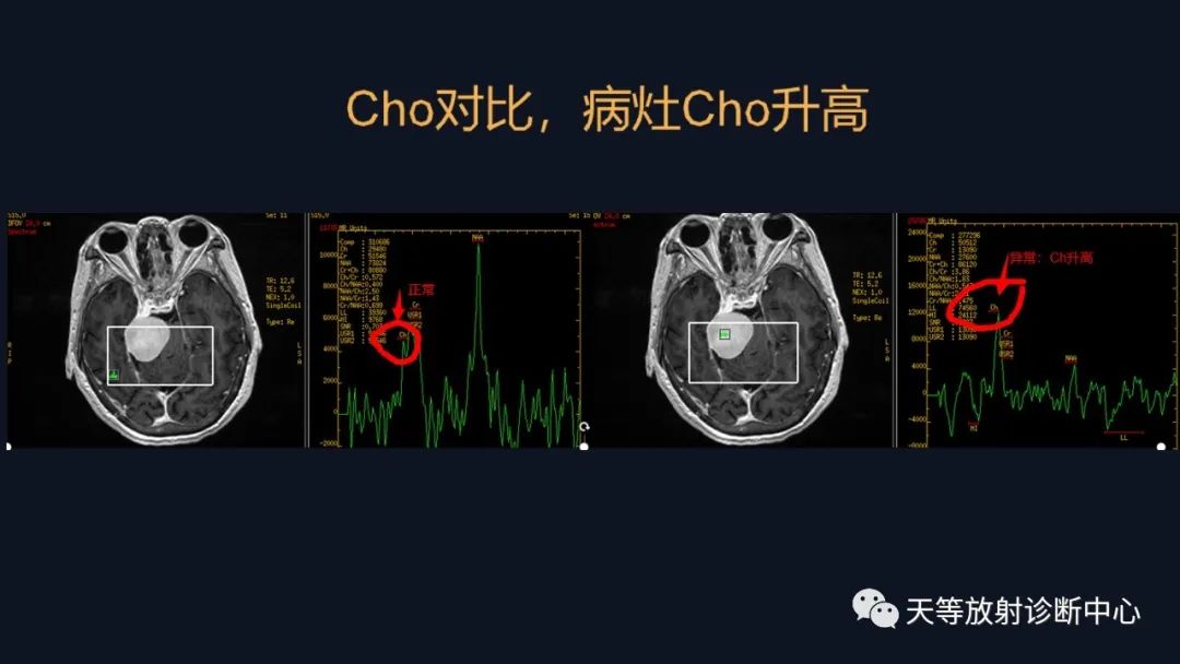 影像PPT - 脑膜瘤影像学分析-35 影像PPT - 脑膜瘤影像学分析-35