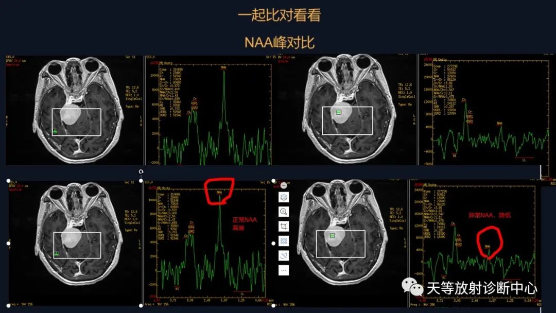 影像PPT - 脑膜瘤影像学分析-34 影像PPT - 脑膜瘤影像学分析-34