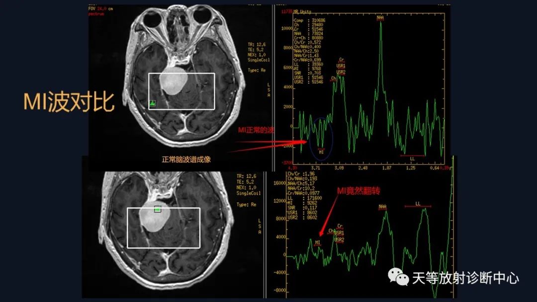 影像PPT - 脑膜瘤影像学分析-37 影像PPT - 脑膜瘤影像学分析-37