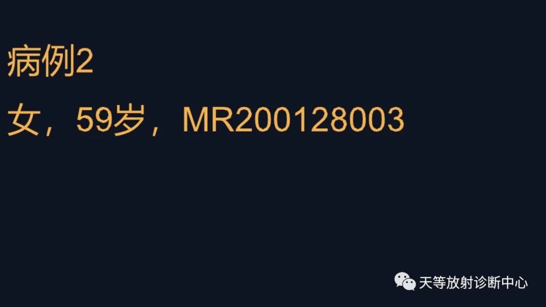影像PPT - 脑膜瘤影像学分析-41 影像PPT - 脑膜瘤影像学分析-41