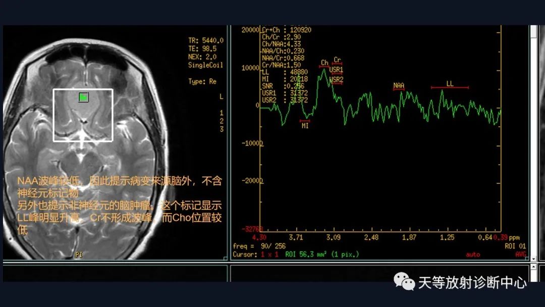 影像PPT - 脑膜瘤影像学分析-47 影像PPT - 脑膜瘤影像学分析-47