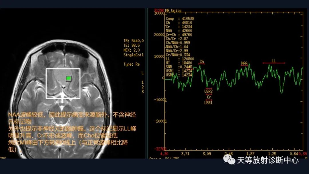 影像PPT - 脑膜瘤影像学分析-48 影像PPT - 脑膜瘤影像学分析-48
