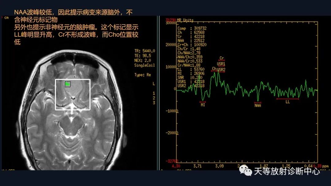 影像PPT - 脑膜瘤影像学分析-49 影像PPT - 脑膜瘤影像学分析-49