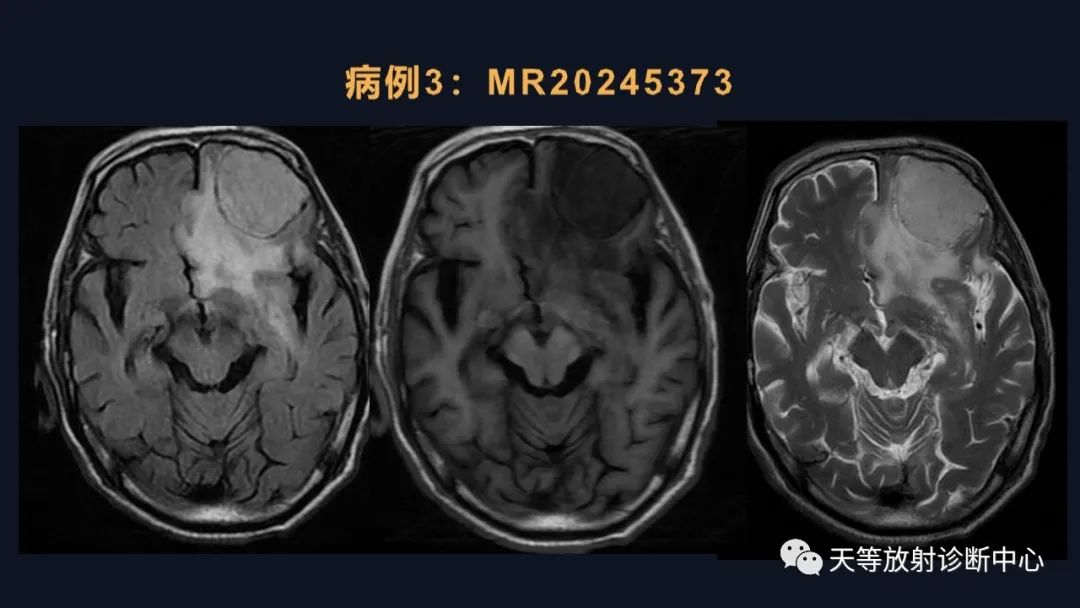 影像PPT - 脑膜瘤影像学分析-51 影像PPT - 脑膜瘤影像学分析-51