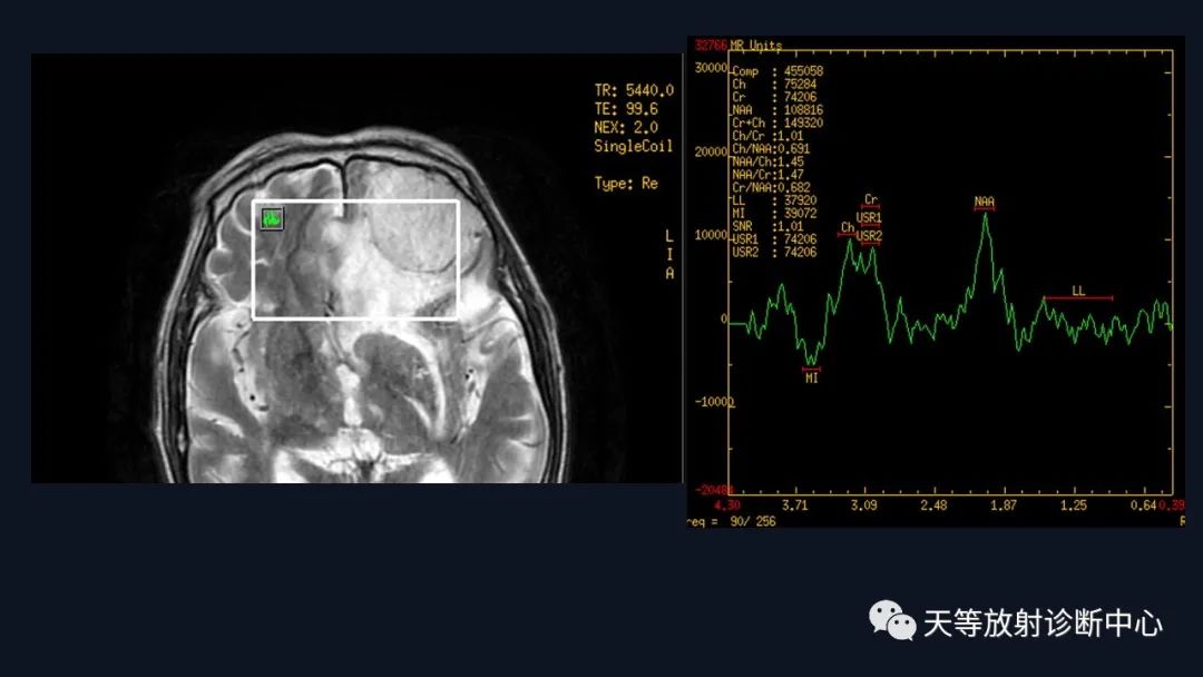 影像PPT - 脑膜瘤影像学分析-54 影像PPT - 脑膜瘤影像学分析-54