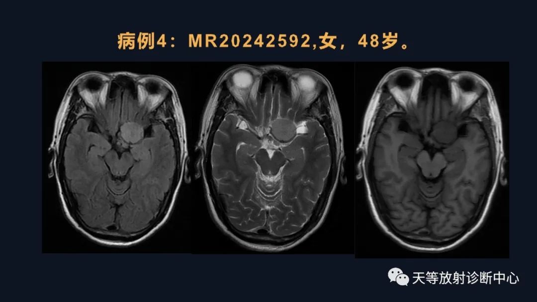 影像PPT - 脑膜瘤影像学分析-55 影像PPT - 脑膜瘤影像学分析-55