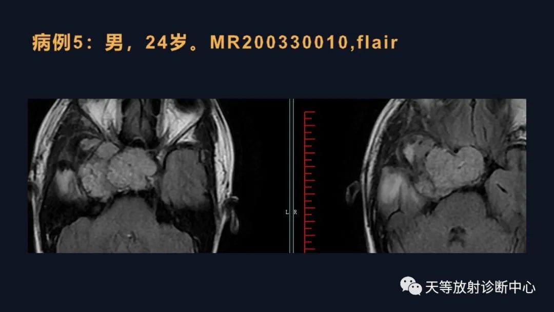 影像PPT - 脑膜瘤影像学分析-58 影像PPT - 脑膜瘤影像学分析-58