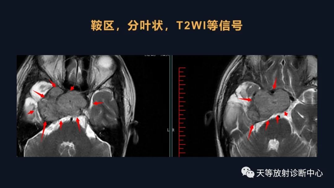 影像PPT - 脑膜瘤影像学分析-62 影像PPT - 脑膜瘤影像学分析-62