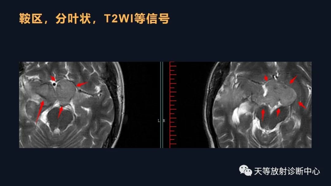 影像PPT - 脑膜瘤影像学分析-63 影像PPT - 脑膜瘤影像学分析-63
