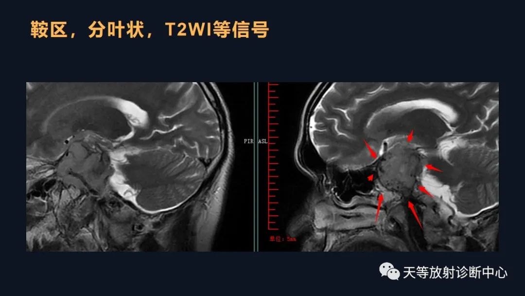 影像PPT - 脑膜瘤影像学分析-64 影像PPT - 脑膜瘤影像学分析-64