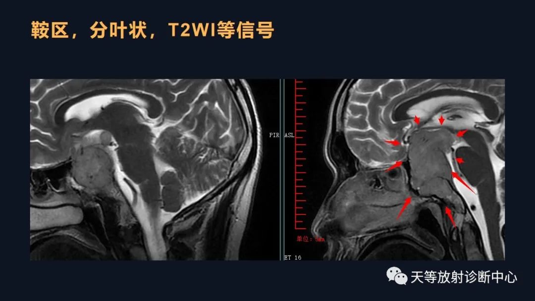 影像PPT - 脑膜瘤影像学分析-65 影像PPT - 脑膜瘤影像学分析-65