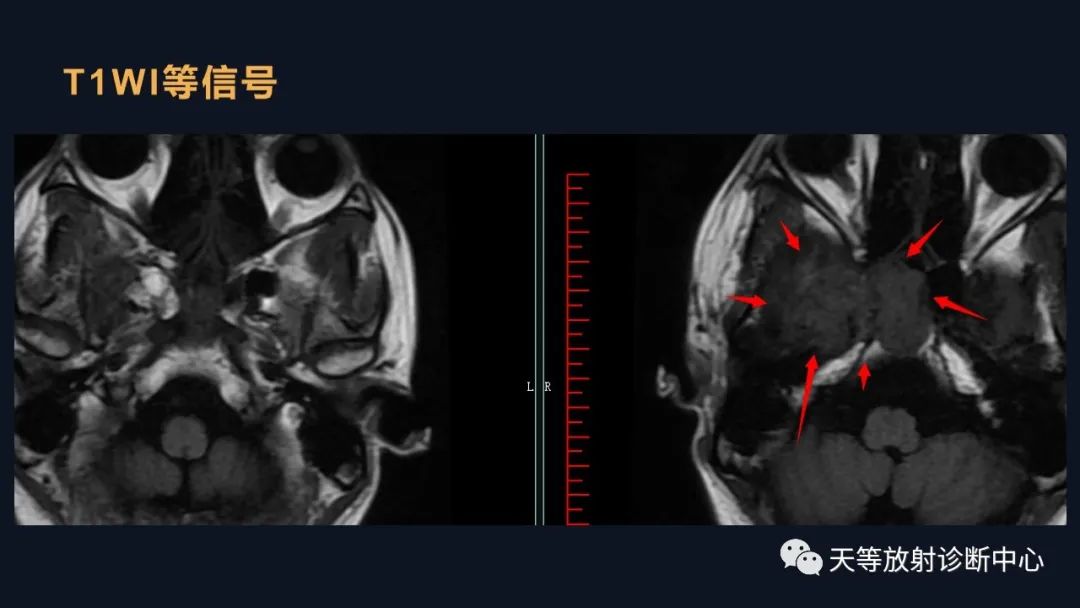 影像PPT - 脑膜瘤影像学分析-66 影像PPT - 脑膜瘤影像学分析-66