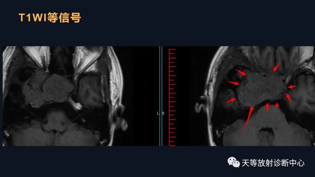 影像PPT - 脑膜瘤影像学分析-67 影像PPT - 脑膜瘤影像学分析-67