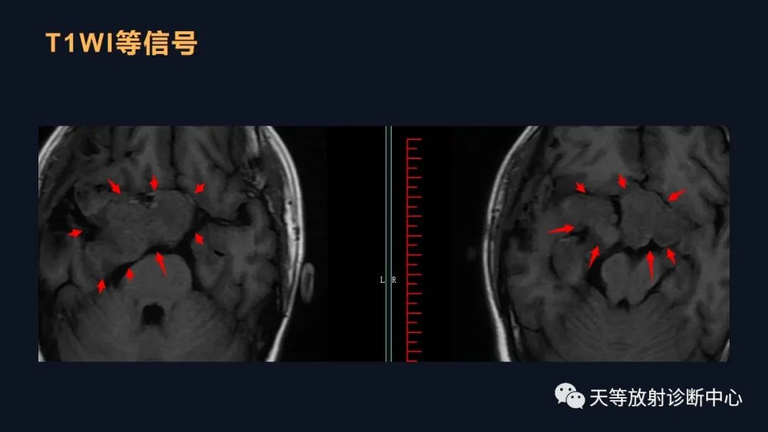 影像PPT - 脑膜瘤影像学分析-68 影像PPT - 脑膜瘤影像学分析-68