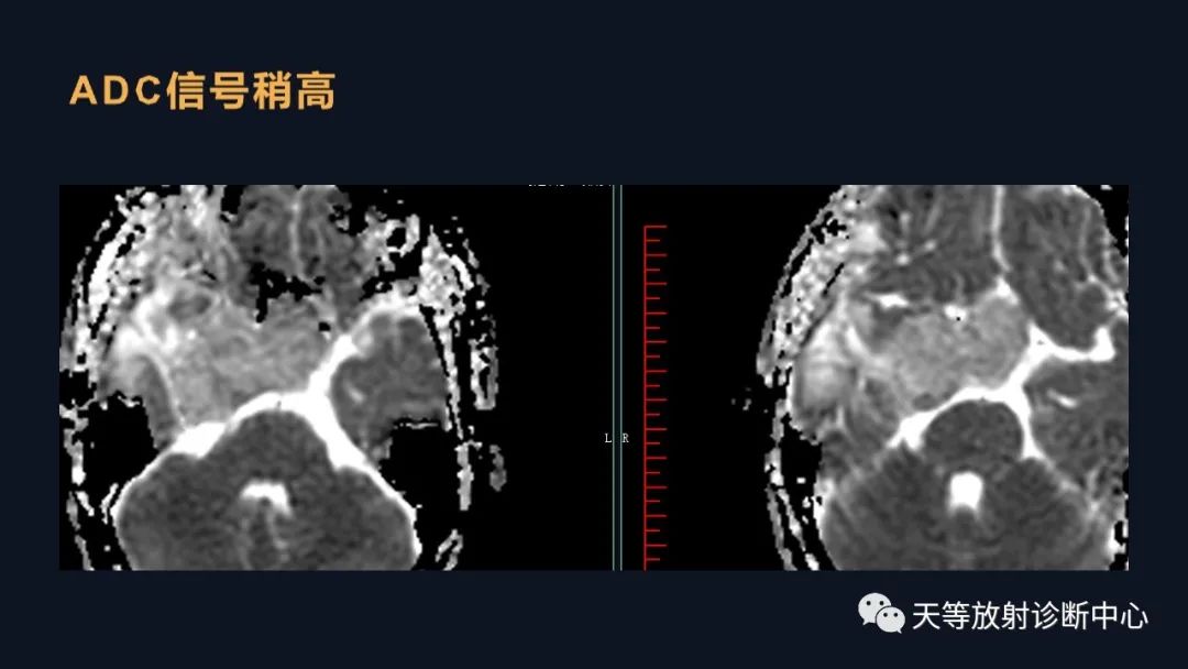 影像PPT - 脑膜瘤影像学分析-70 影像PPT - 脑膜瘤影像学分析-70