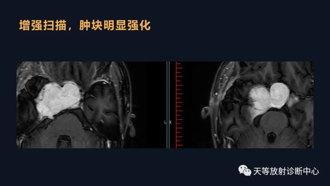影像PPT - 脑膜瘤影像学分析-81 影像PPT - 脑膜瘤影像学分析-81