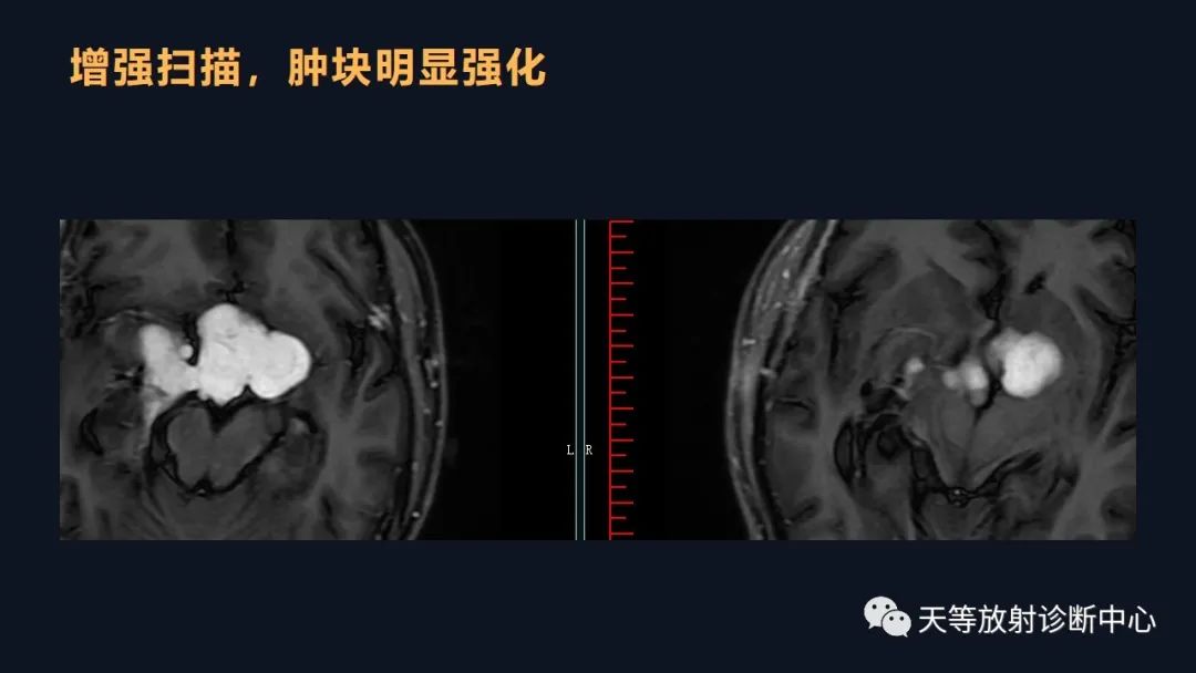 影像PPT - 脑膜瘤影像学分析-82 影像PPT - 脑膜瘤影像学分析-82