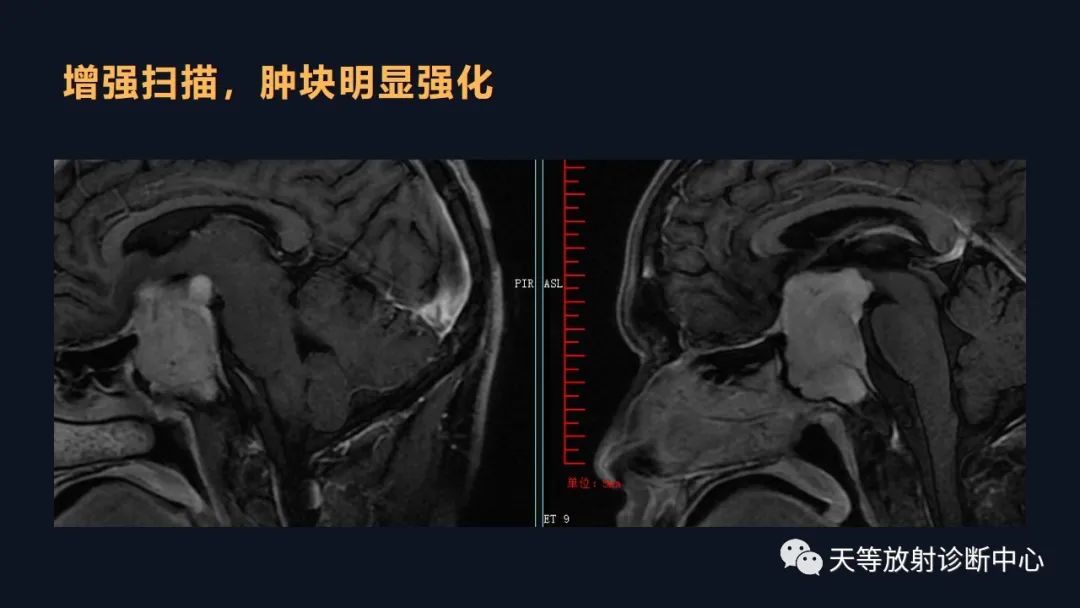 影像PPT - 脑膜瘤影像学分析-83 影像PPT - 脑膜瘤影像学分析-83