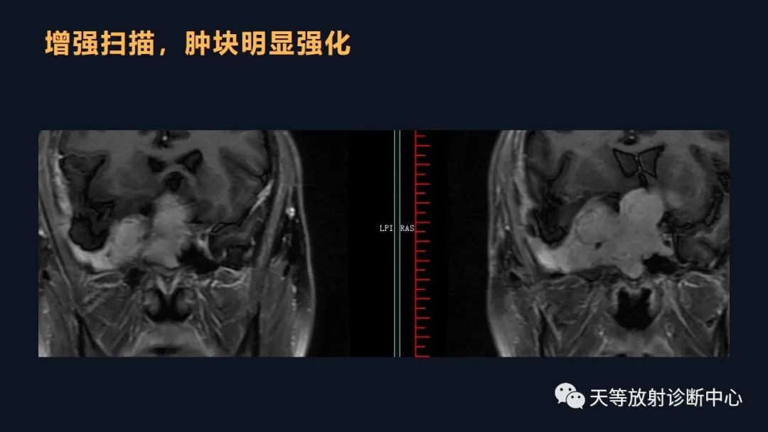 影像PPT - 脑膜瘤影像学分析-84 影像PPT - 脑膜瘤影像学分析-84