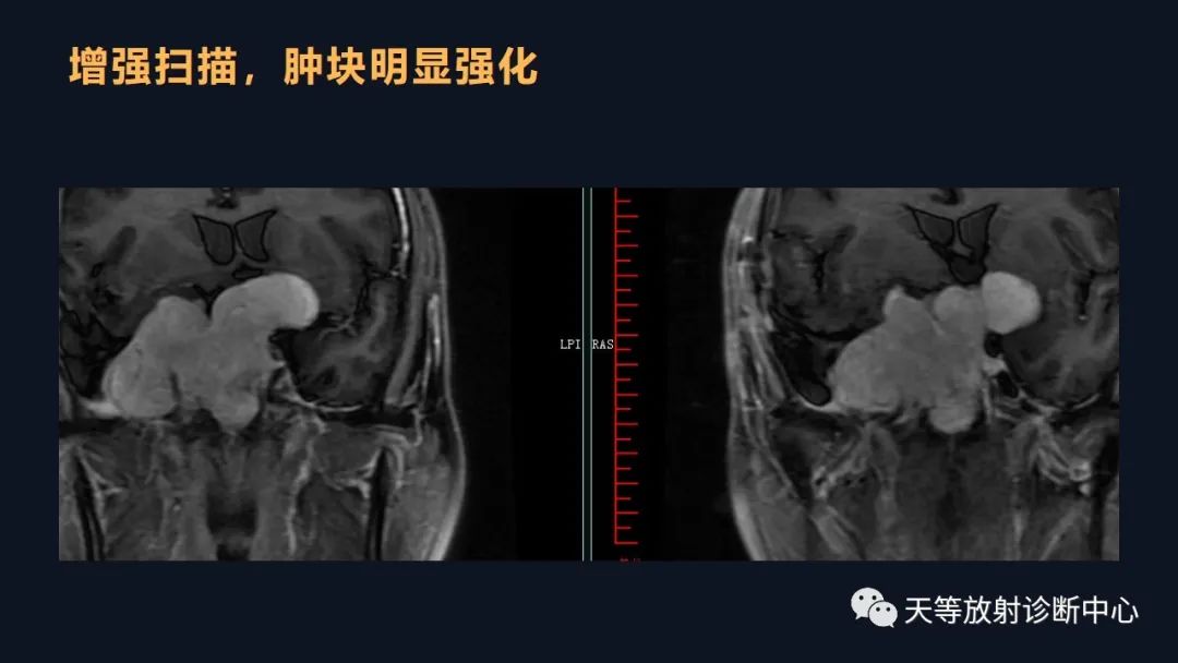 影像PPT - 脑膜瘤影像学分析-85 影像PPT - 脑膜瘤影像学分析-85