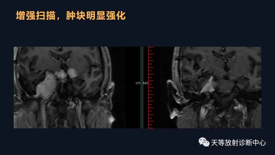 影像PPT - 脑膜瘤影像学分析-86 影像PPT - 脑膜瘤影像学分析-86