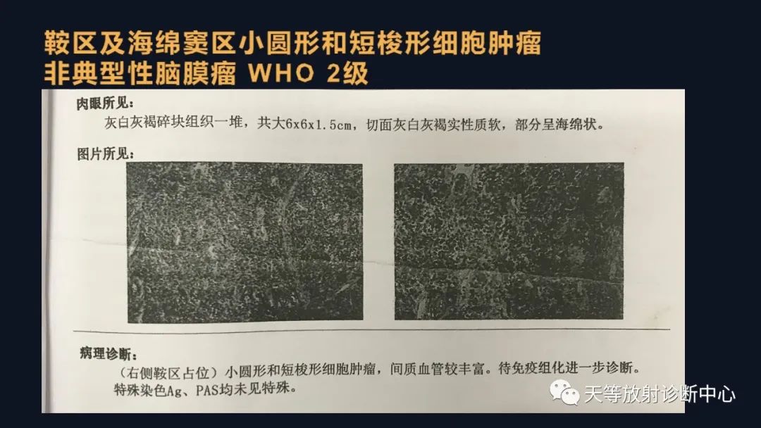 影像PPT - 脑膜瘤影像学分析-89 影像PPT - 脑膜瘤影像学分析-89