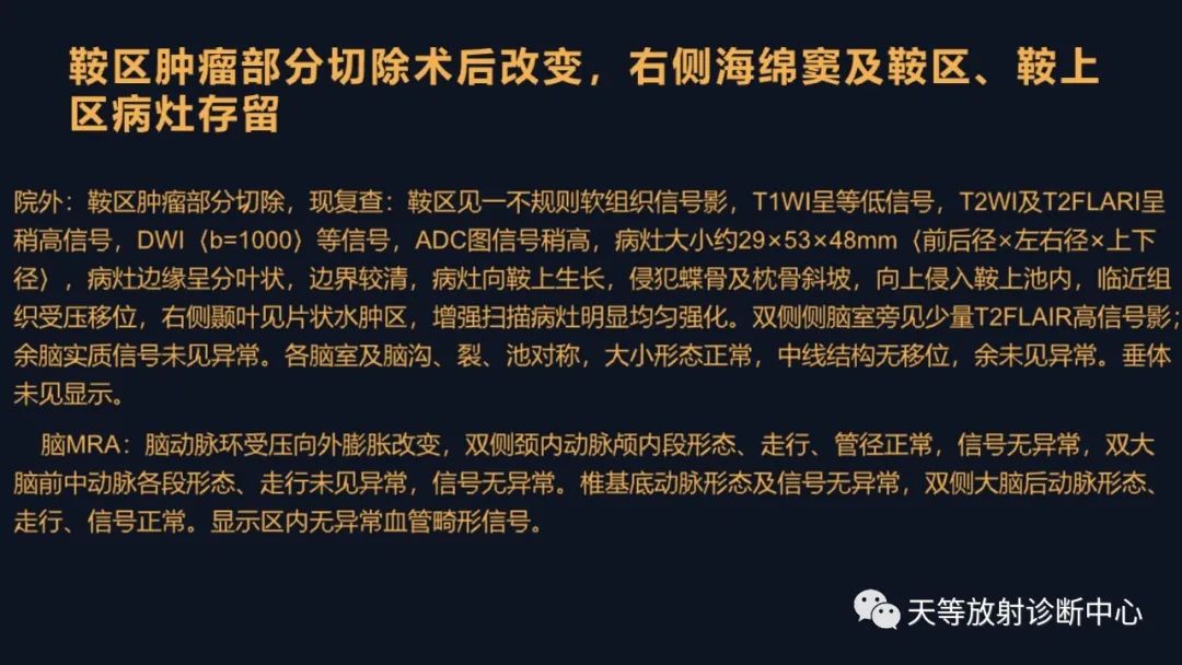 影像PPT - 脑膜瘤影像学分析-90 影像PPT - 脑膜瘤影像学分析-90