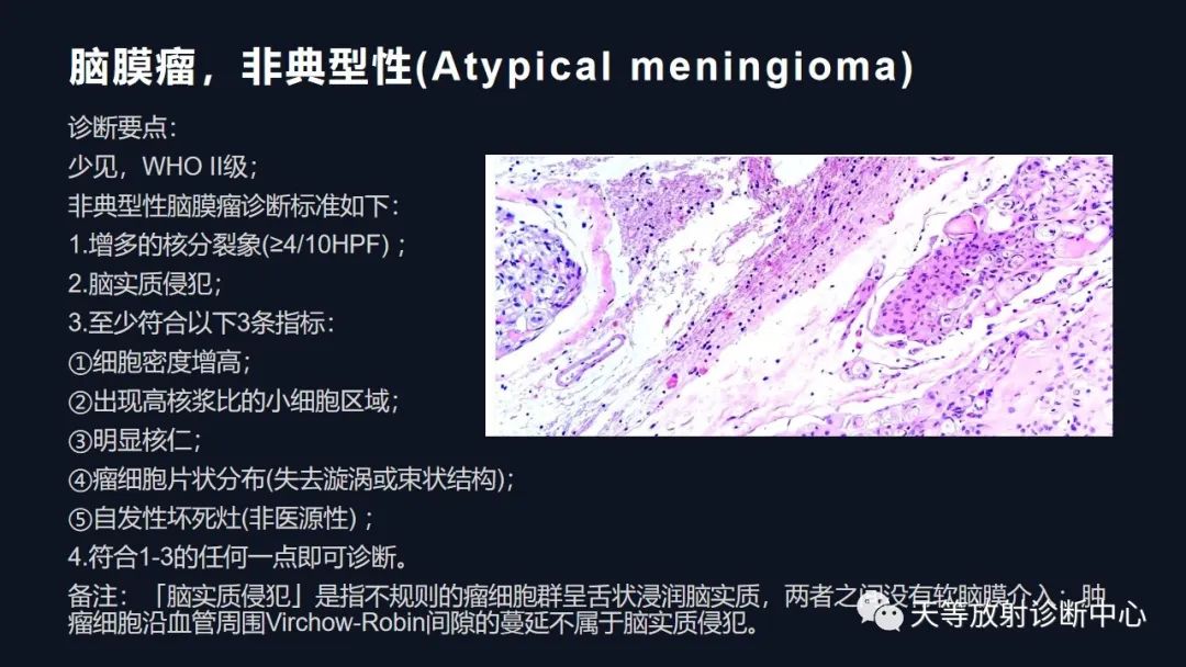 影像PPT - 脑膜瘤影像学分析-96 影像PPT - 脑膜瘤影像学分析-96