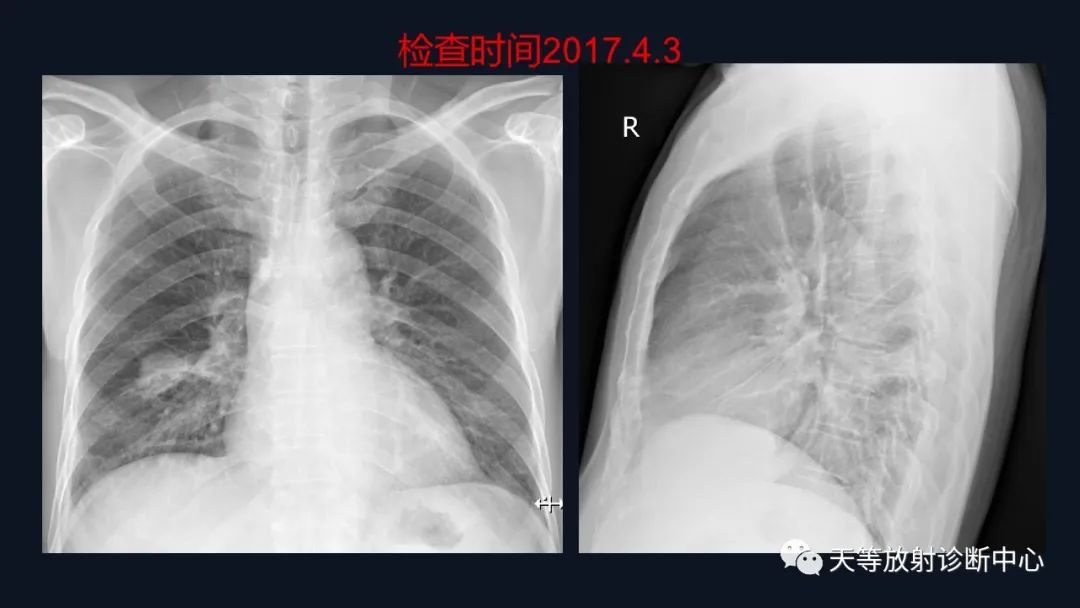 影像PPT - 【病例】张牙舞爪肺腺癌1例CT影像-2 影像PPT - 【病例】张牙舞爪肺腺癌1例CT影像-2