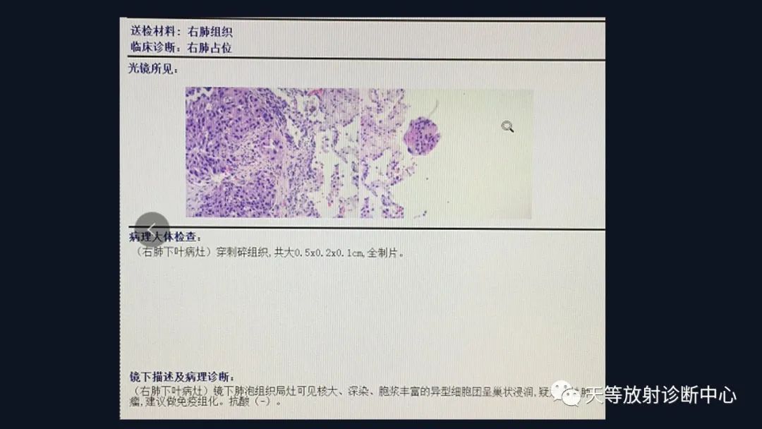 影像PPT - 【病例】张牙舞爪肺腺癌1例CT影像-27 影像PPT - 【病例】张牙舞爪肺腺癌1例CT影像-27