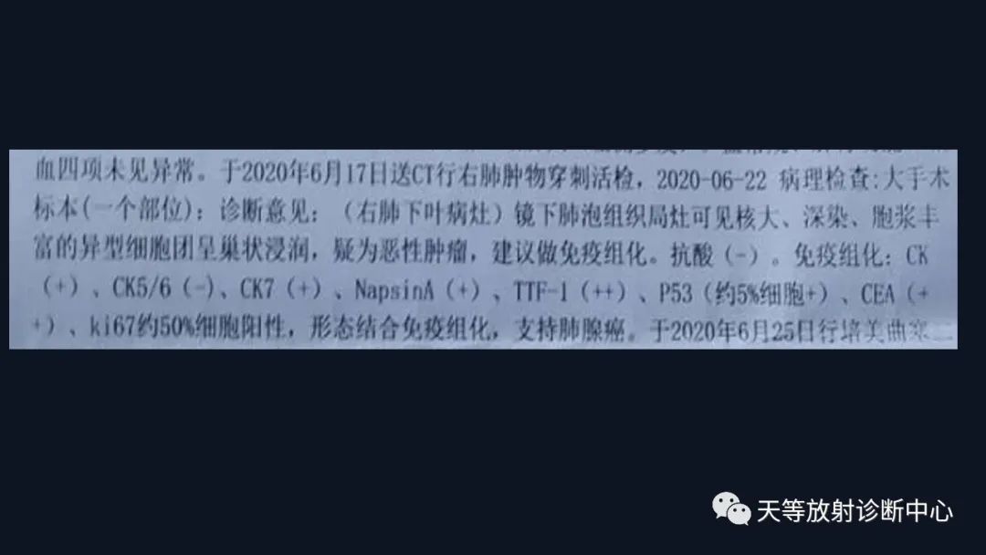 影像PPT - 【病例】张牙舞爪肺腺癌1例CT影像-28 影像PPT - 【病例】张牙舞爪肺腺癌1例CT影像-28